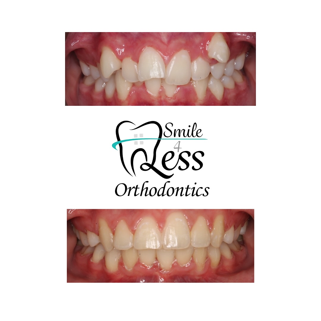 Before and after braces