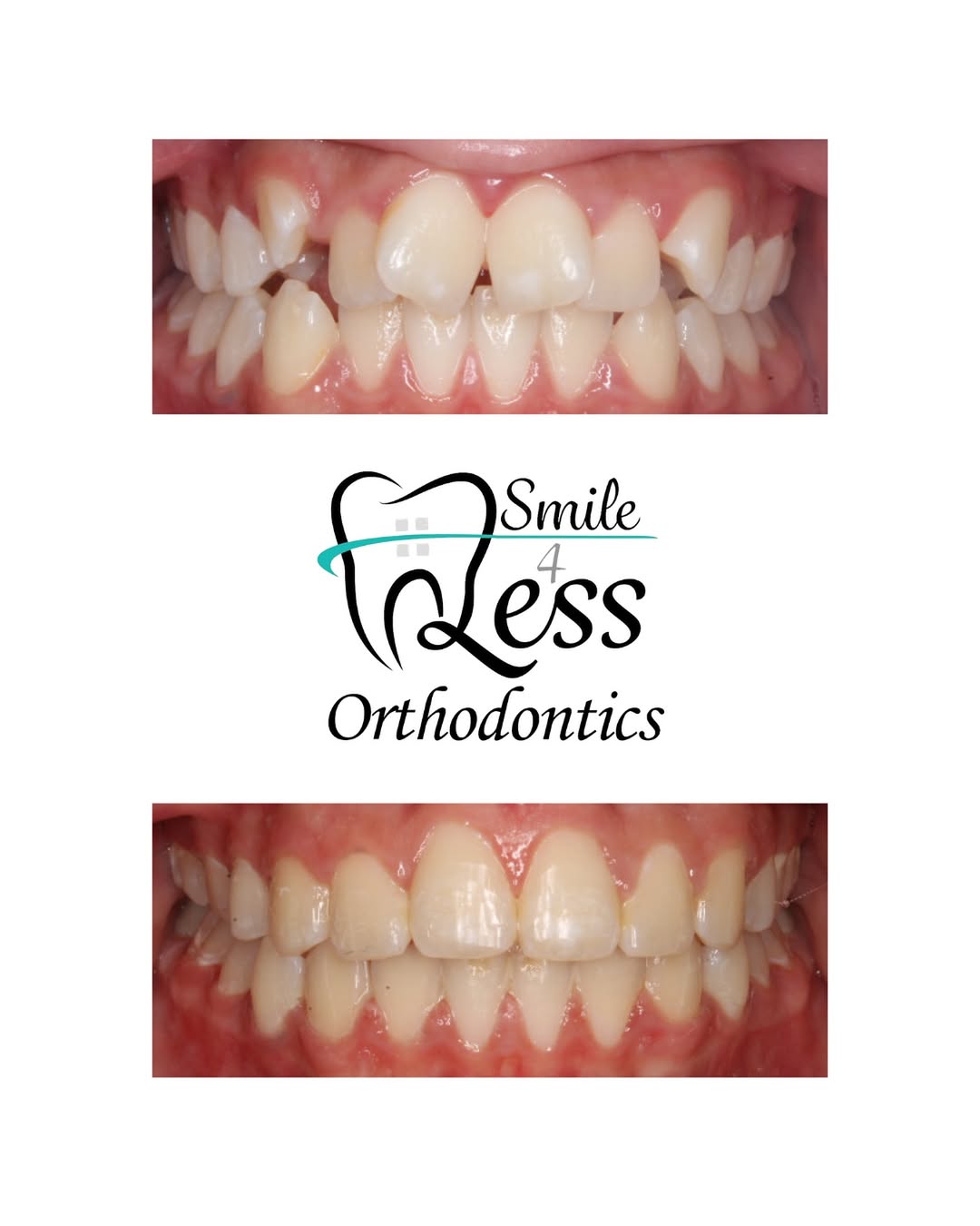 Before and after braces