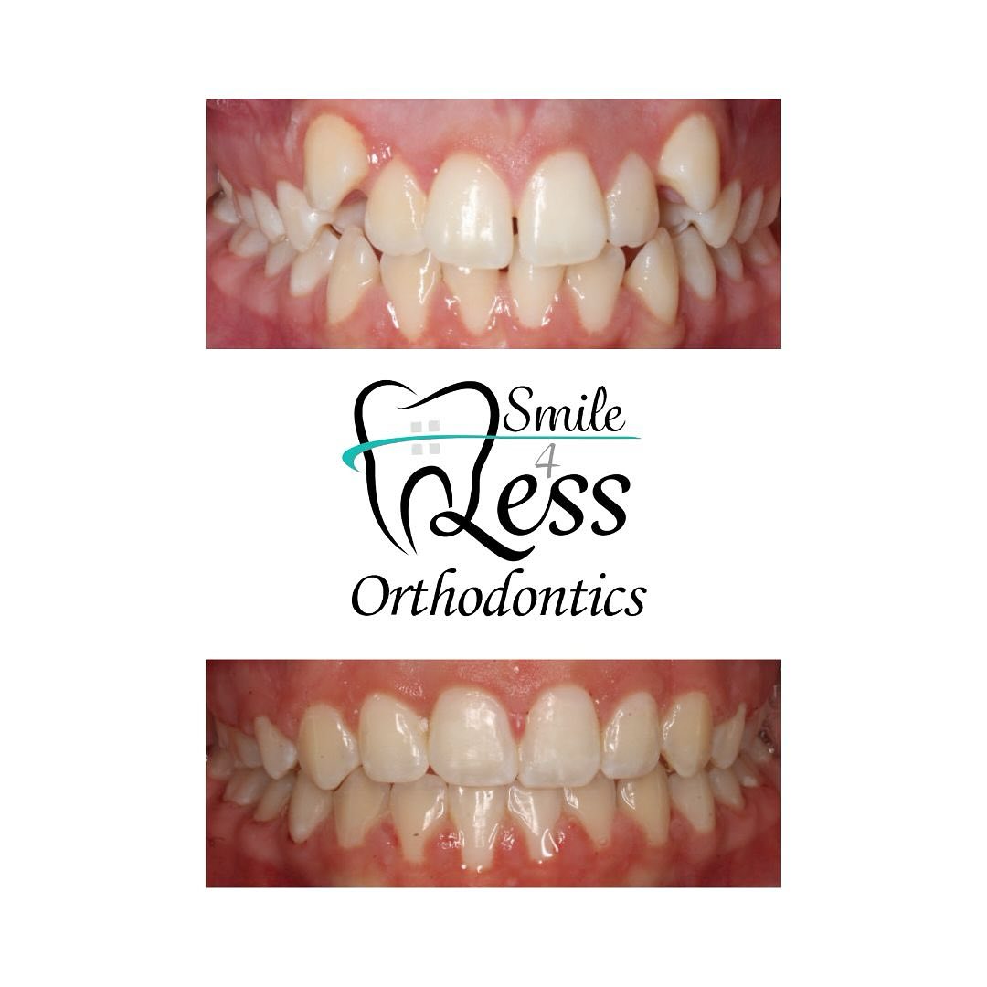 Before and after braces