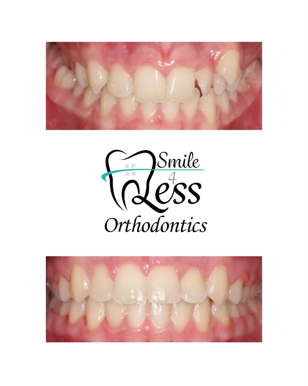 Before and after braces