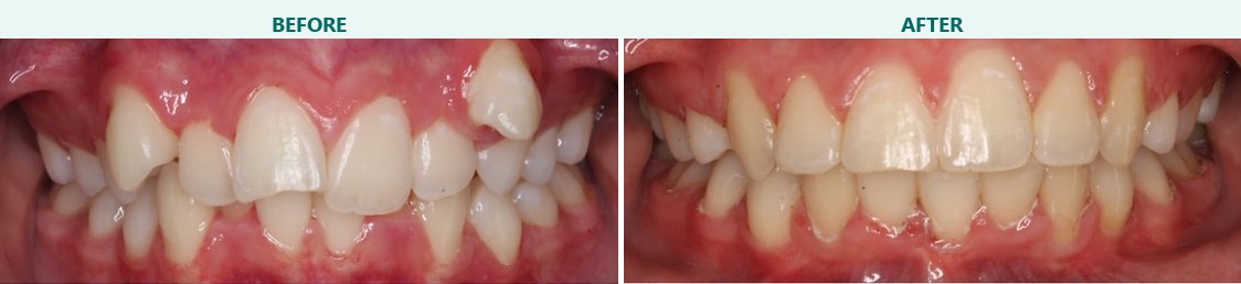 Crowding corrected with braces, before and after braces at Smile 4 Less