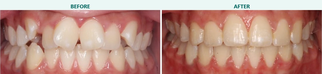 Spacing closed with braces, before and after braces at Smile 4 Less