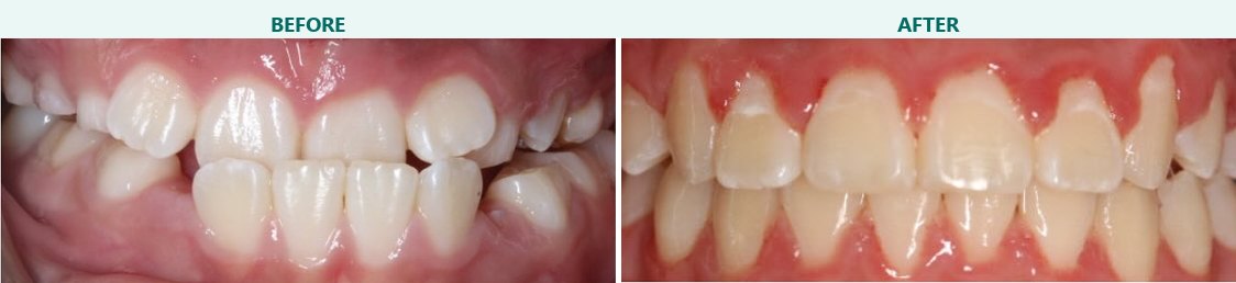 Alignment and bite improvement, before and after braces at Smile 4 Less