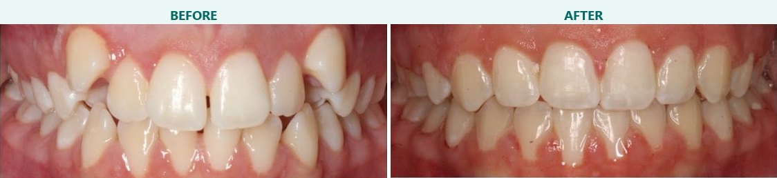 Crowding corrected with braces, before and after braces at Smile 4 Less