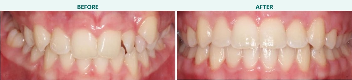 Alignment improvement, before and after braces at Smile 4 Less