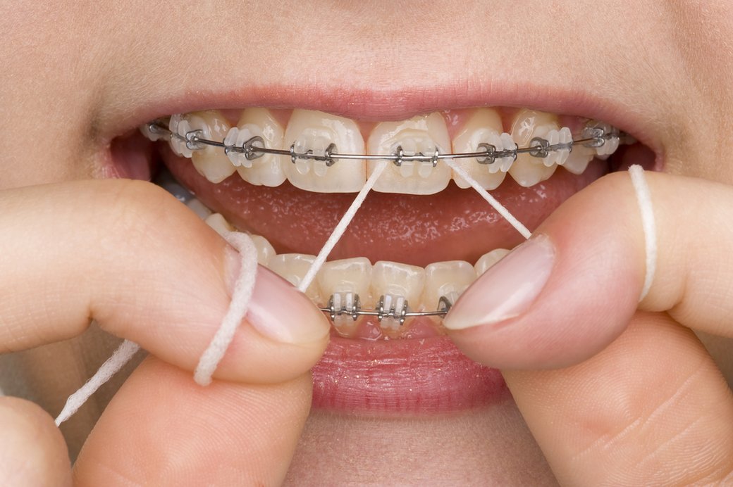 Flossing under the archwire with a threader