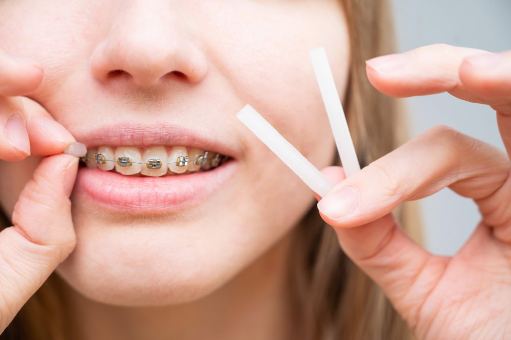 A patient with braces holding strips of orthodontic relief wax