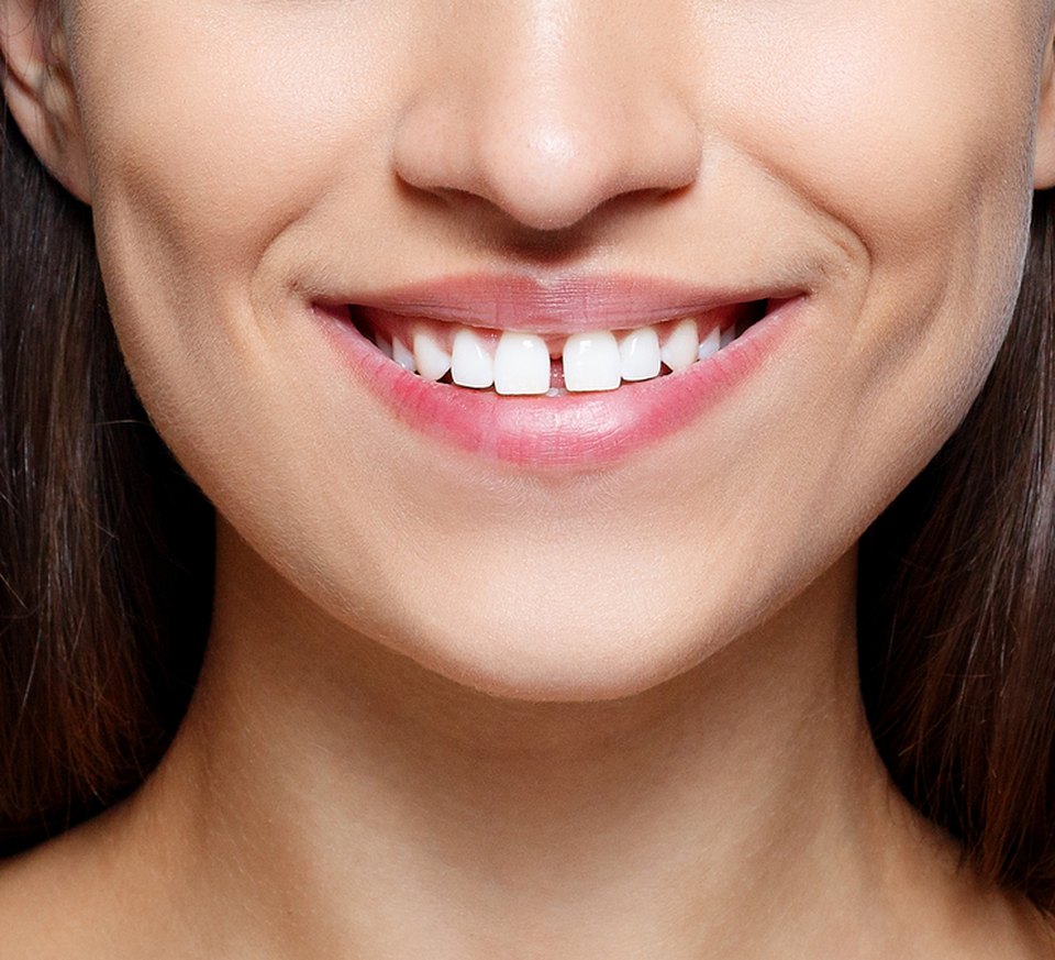 A smile with a gap between the front teeth