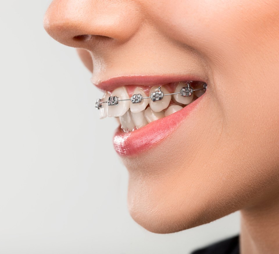 Profile view of a smile with braces