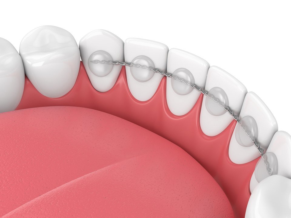 A bonded permanent retainer wire behind the lower front teeth